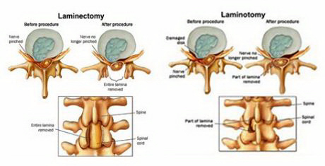 Laminectomy vs. Laminotomy.JPG