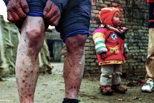 2002年，一位因卖血患爱滋病的病人，腿部多处腿部多处脓疱疮（高耀洁提供）.jpg