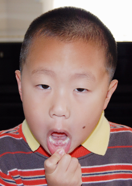 1766122492709986.jpg 2008-05-18_Ectopic Eruption in Lower Incisors0001.JPG