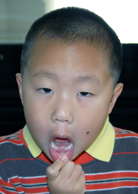 1768094357831347.jpg 2008-05-18_Ectopic Eruption in Lower Incisors 下切牙异位萌出0001.JPG
