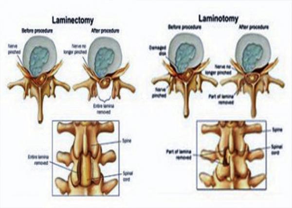 Laminectomy vs. Laminotomy.JPG
