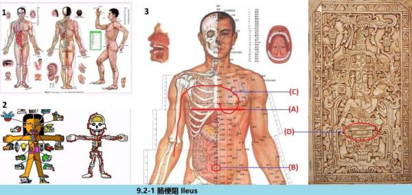 9.2-1 420 ������ Ileus.jpg