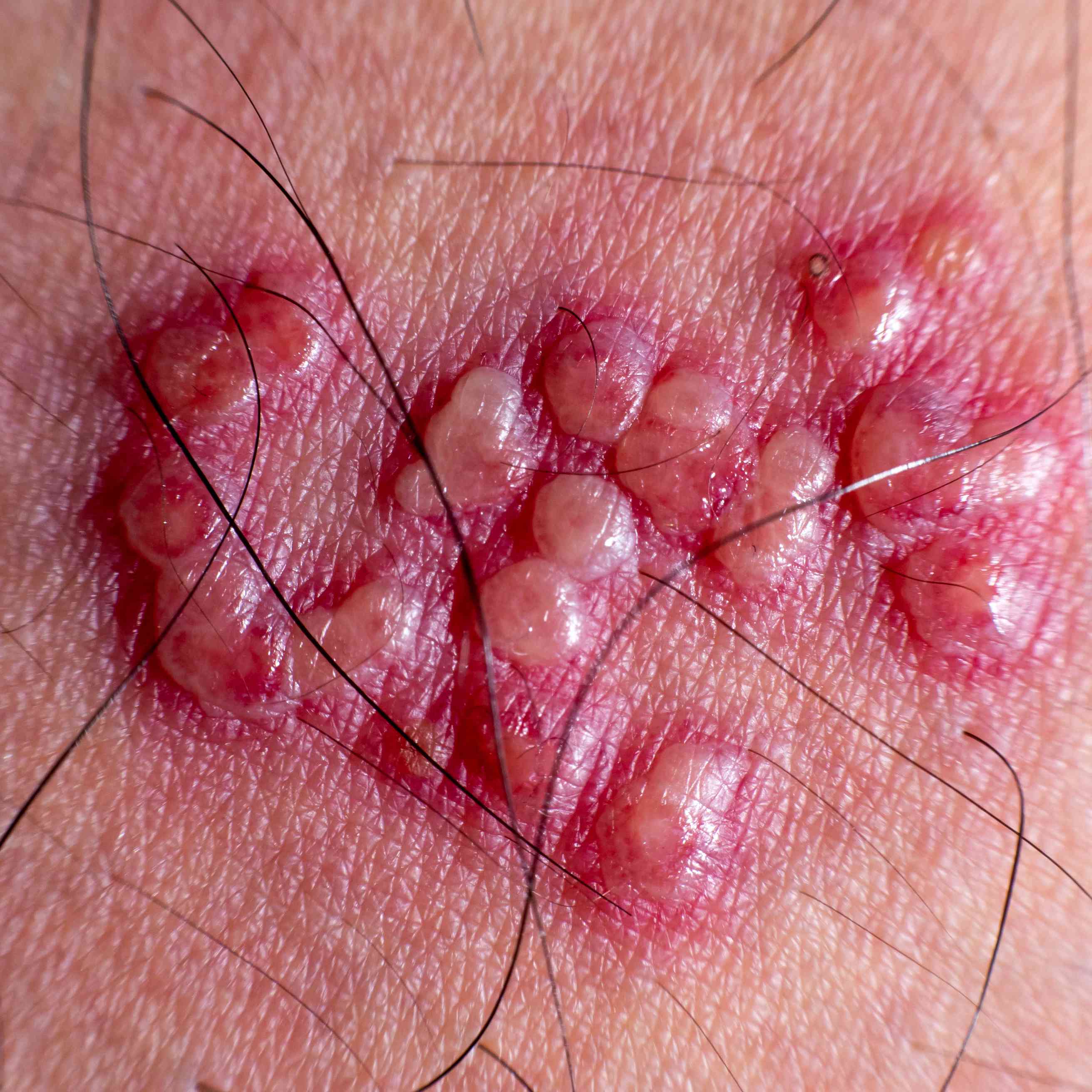 Shingles Pictures: What Does a Shingles Rash Look Like?